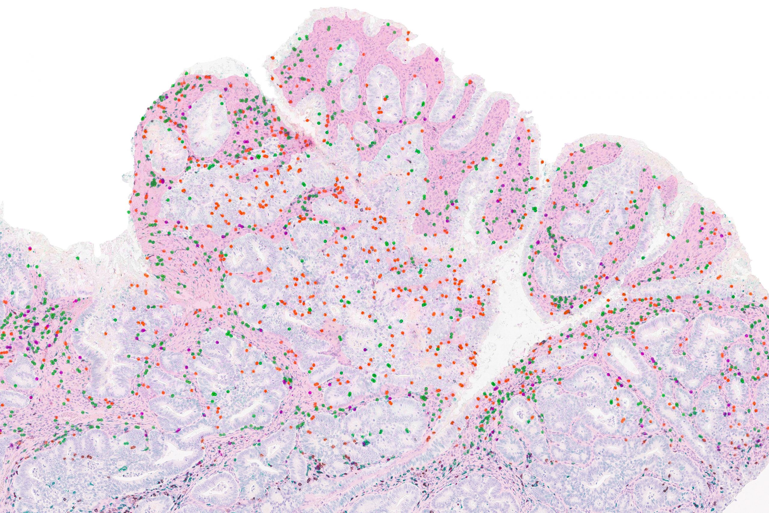 Study explains why certain immunotherapies don’t always work as predicted